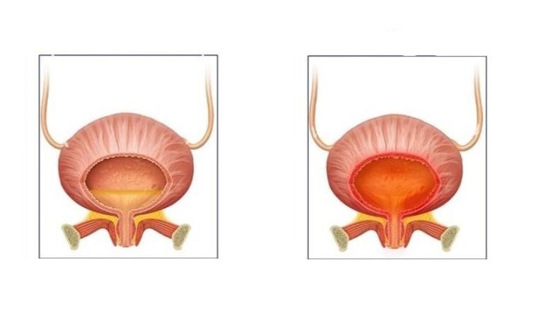 Normal et les patients atteints de cystite des voies urinaires