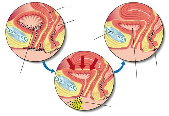 bactéries dans la vessie avec cystite