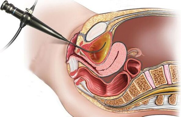 cystoscopie pour la cystite