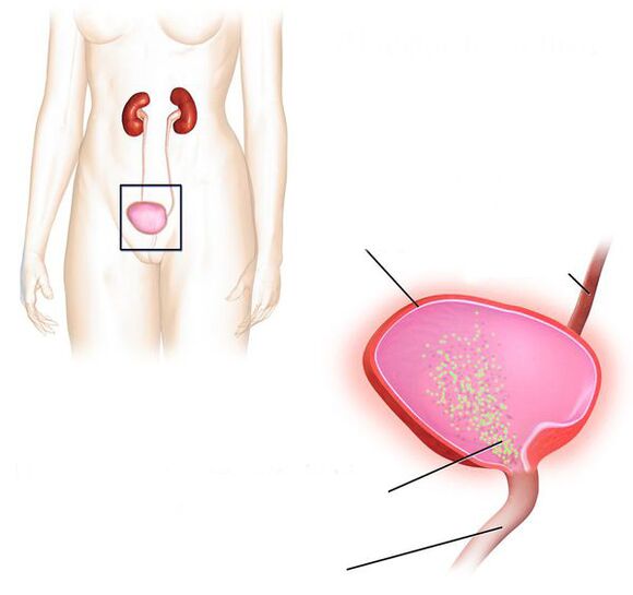 inflammation de la vessie
